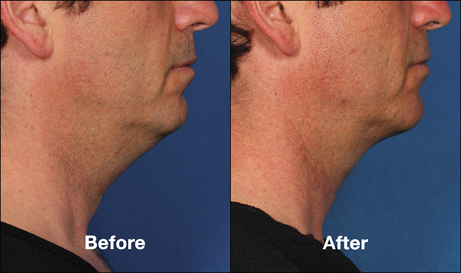 chin fat reduction for men 