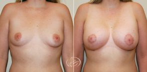 breast-augmentation-03a