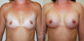 breast-augmentation-04a