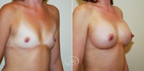 breast-augmentation-04b