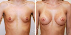breast-augmentation-05a