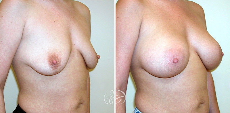breast-augmentation-07b