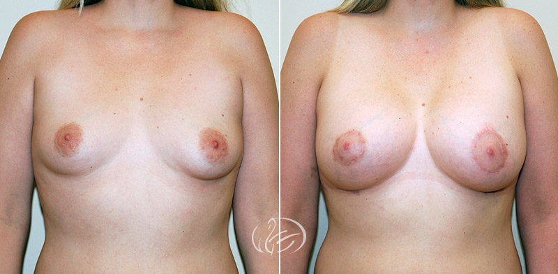 breast-augmentation-with-lift-03a