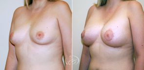 breast-augmentation-with-lift-03b