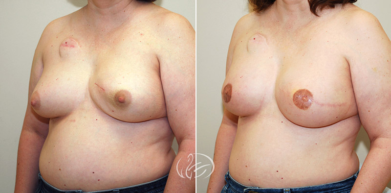 breast-reconstruction-01b-thor
