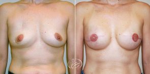 breast-reconstruction-02a
