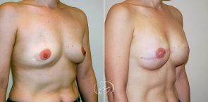 breast-reconstruction-02b