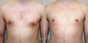 Male Chest Contouring