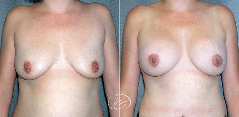 breast-augmentation-10896a-thors