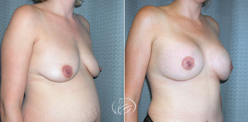 breast-augmentation-10896b-thors