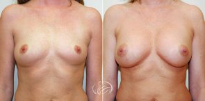 breast-augmentation-9871a-thors