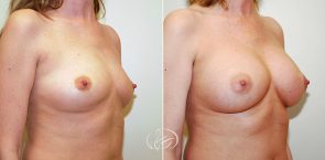 breast-augmentation-9871b-thors
