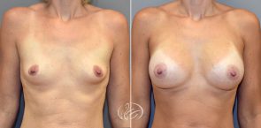 breast-augmentation-9878a-thors