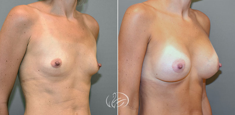 breast-augmentation-9878b-thors
