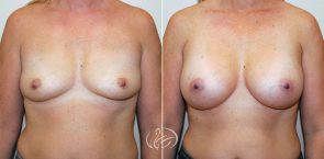 breast-augmentation-9886a-thors
