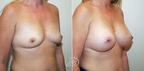 breast-augmentation-9886b-thors