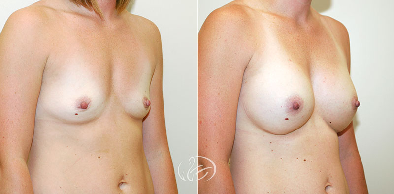 breast-augmentation-12258b-thors