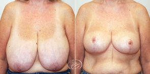 breast-reduction-12272a-thors