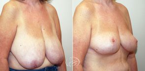 breast-reduction-12272b-thors