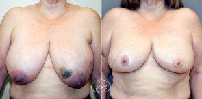 breast-reconstruction-12583a-thors