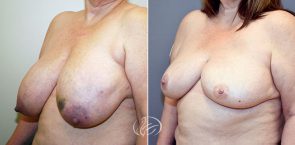 breast-reconstruction-12583b-thors