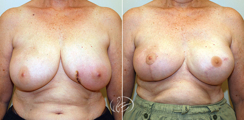 breast-reconstruction-12711a-thors