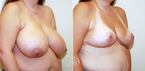 breast-reduction-12607b-thors